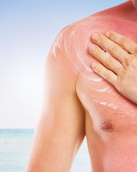 Skin Cancer Risks